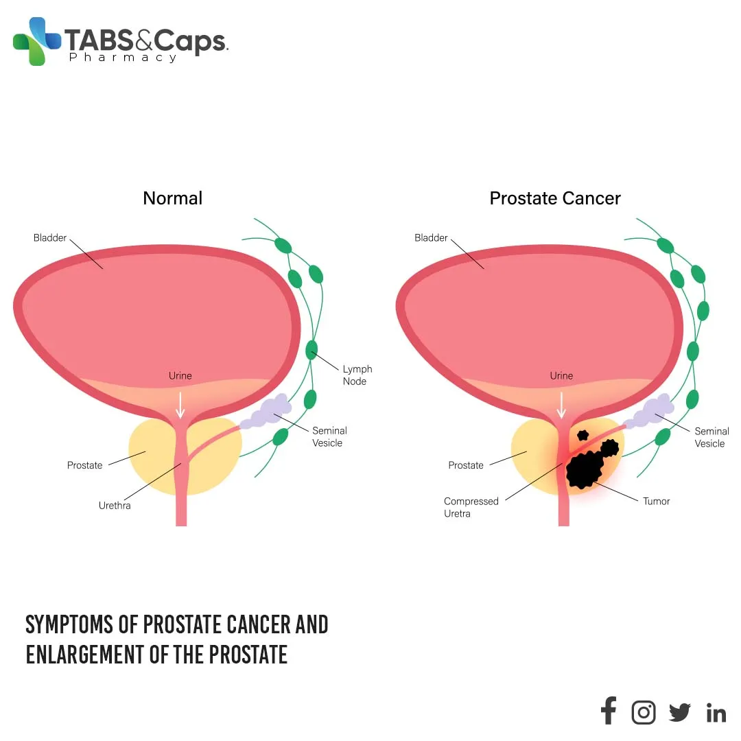 Symptoms-of-prostate-cancer-and-enlargement-of-the-prostate